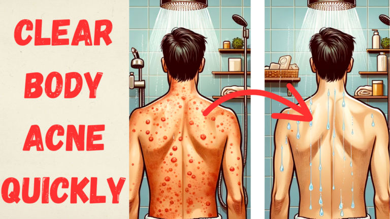 How To Get Rid of Back Acne Quick